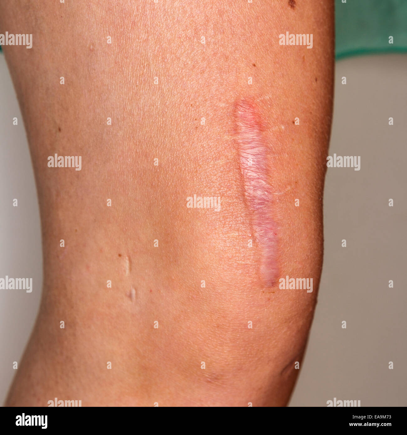 Close up of young woman's leg and knee with large scar after several knee surgical operations  Model Release: No.  Property Release: No. Stock Photo