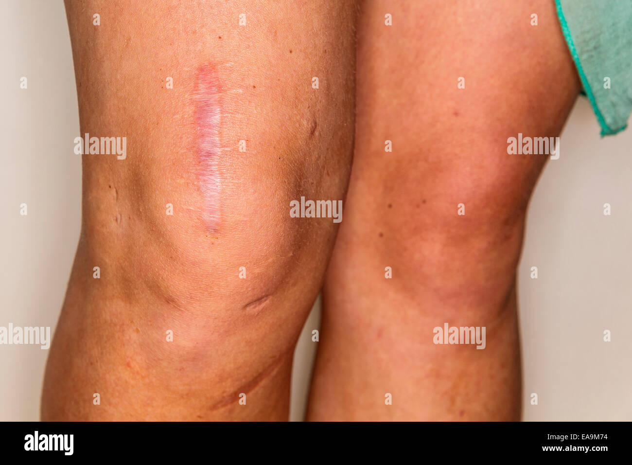 Close up of young woman's leg and knee with large scar after several knee surgical operations  Model Release: No.  Property Release: No. Stock Photo