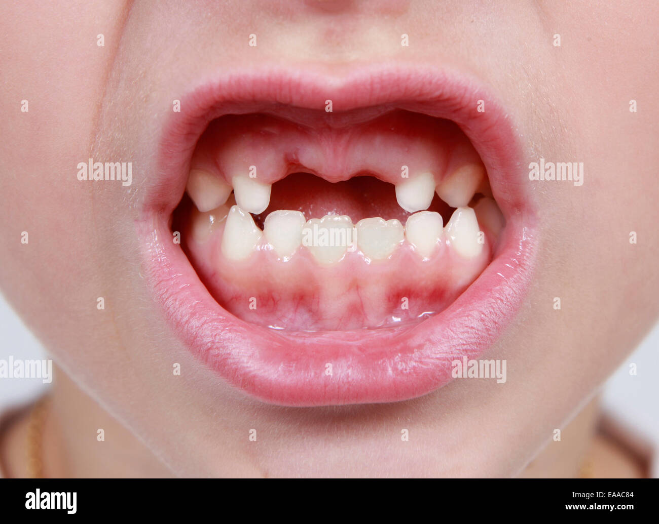 Closeup of child's month with missing teeth Stock Photo