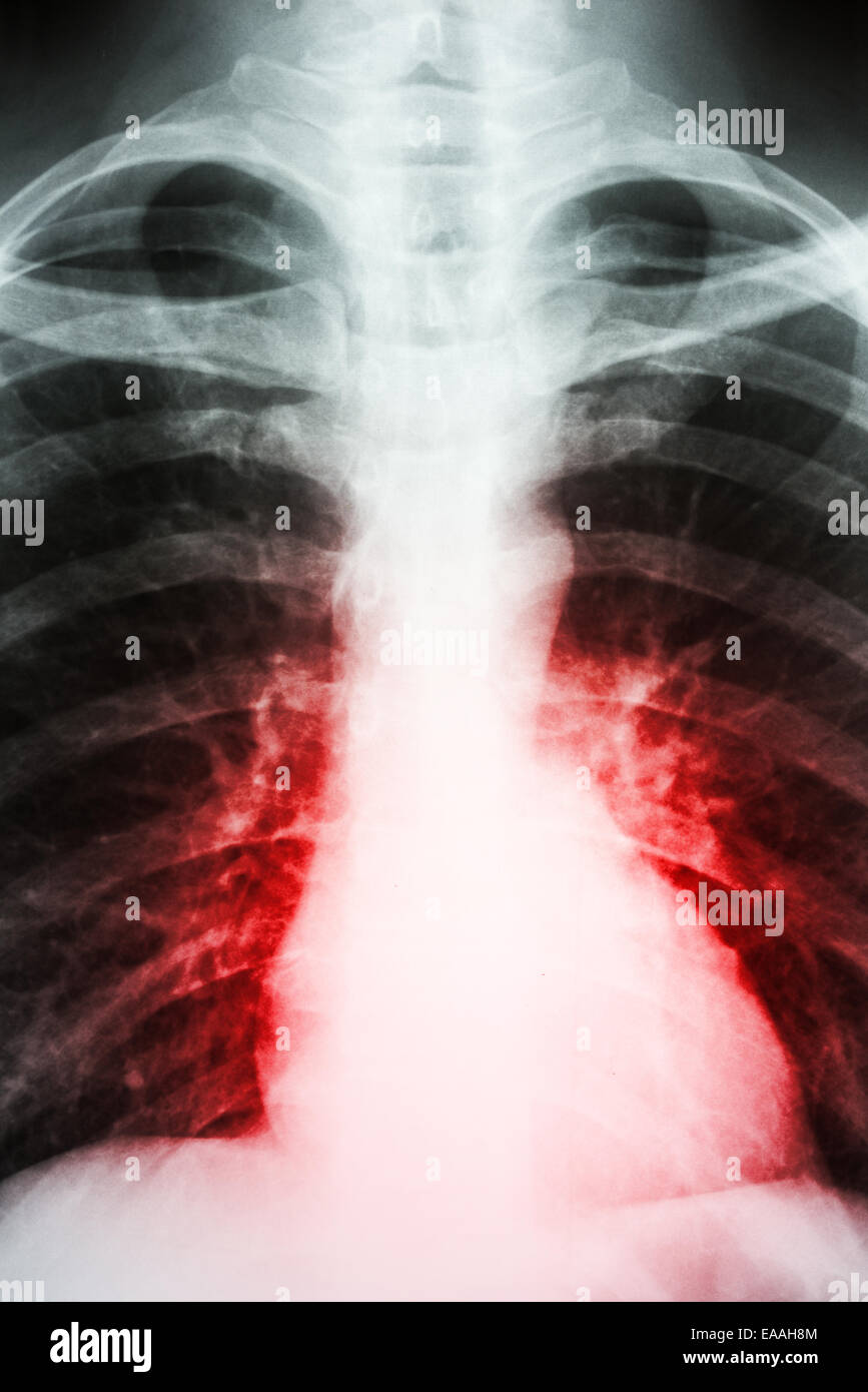Heart Disease Symptom On Patient X-Ray Stock Photo