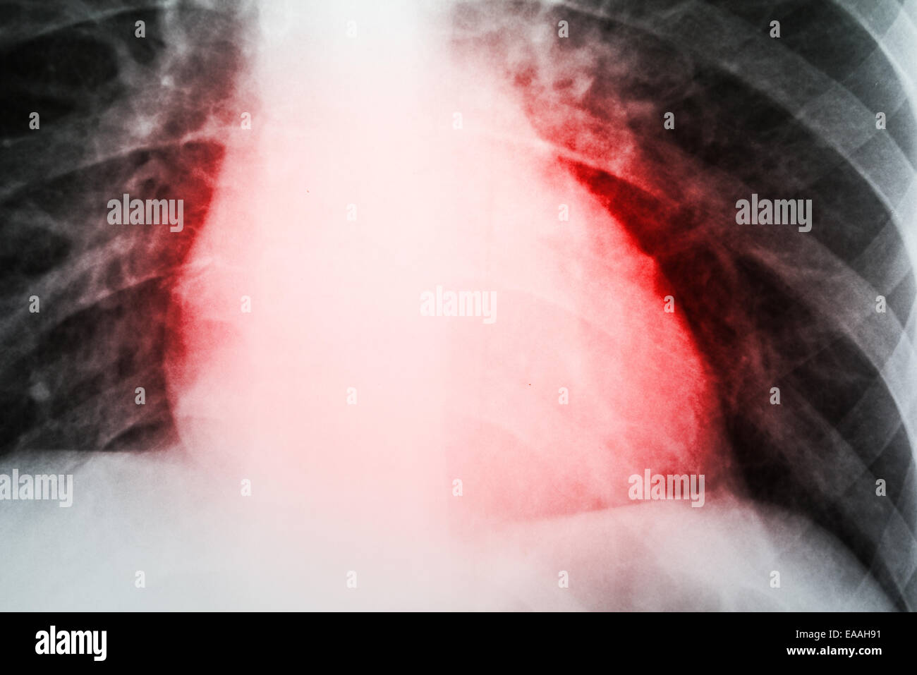 Heart Attack On Patient X-Ray Stock Photo