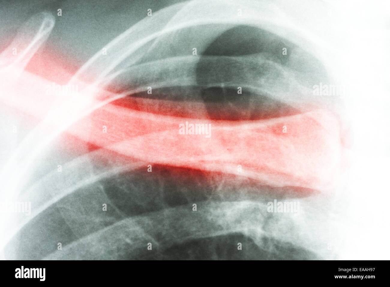X-Ray Of Collar Bone Pain Stock Photo