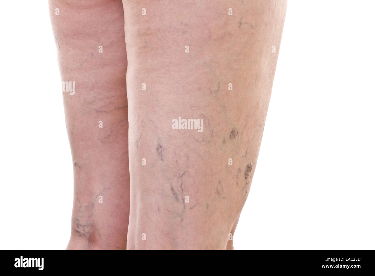 Legs with varicose veins Stock Photo
