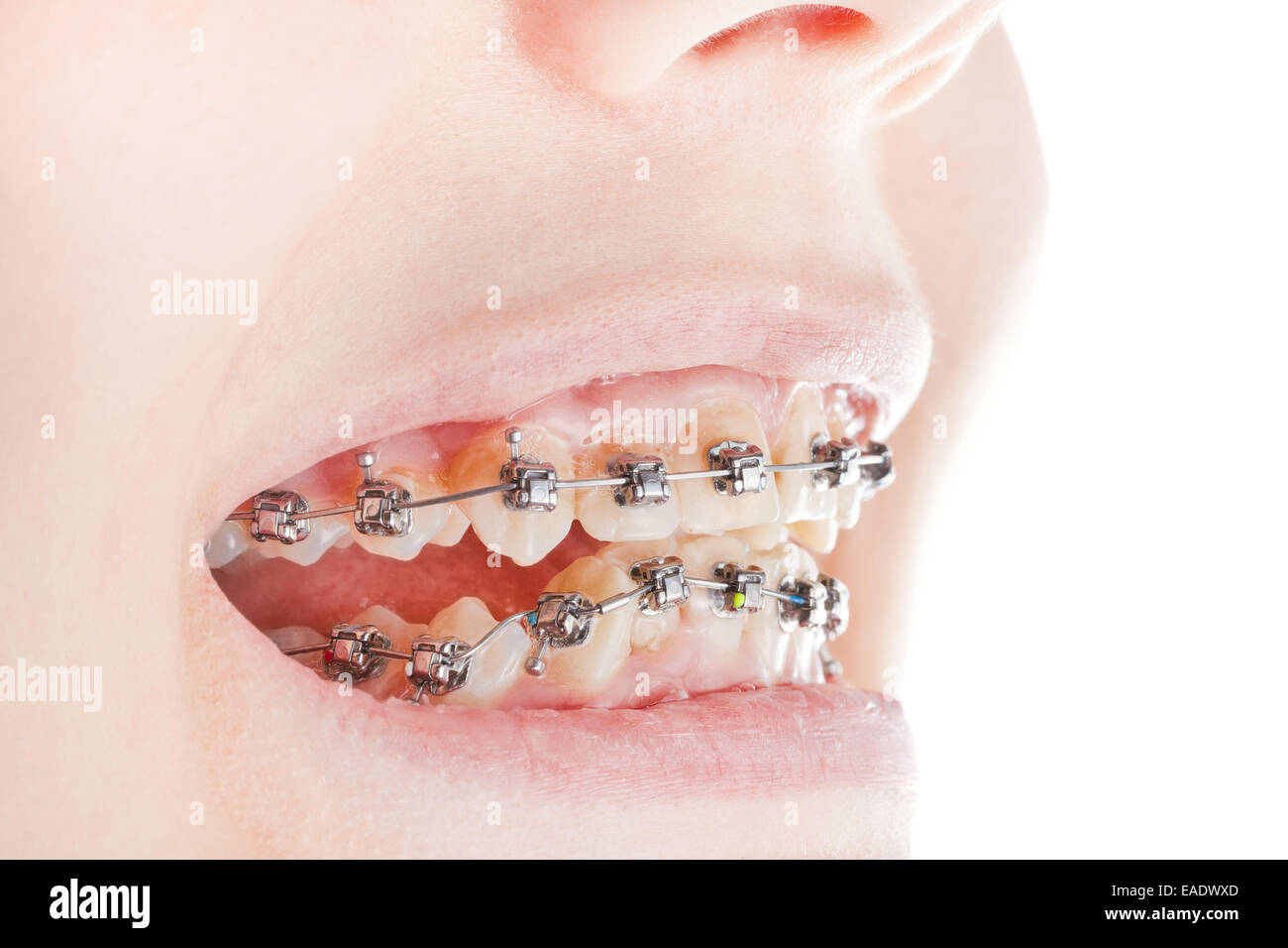 dental braces on teeth close up during orthodontic treatment Stock ...