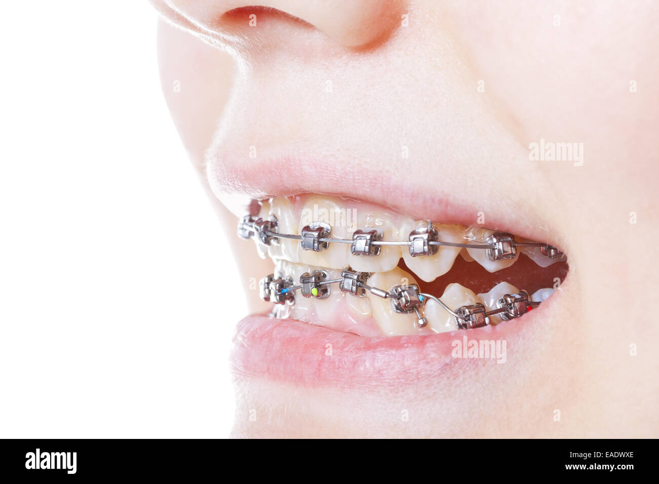 dental steel braces on teeth close up during orthodontic treatment Stock Photo