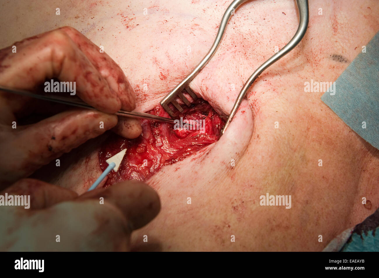 A surgeon is looking cautious for an important vain to operate Stock Photo