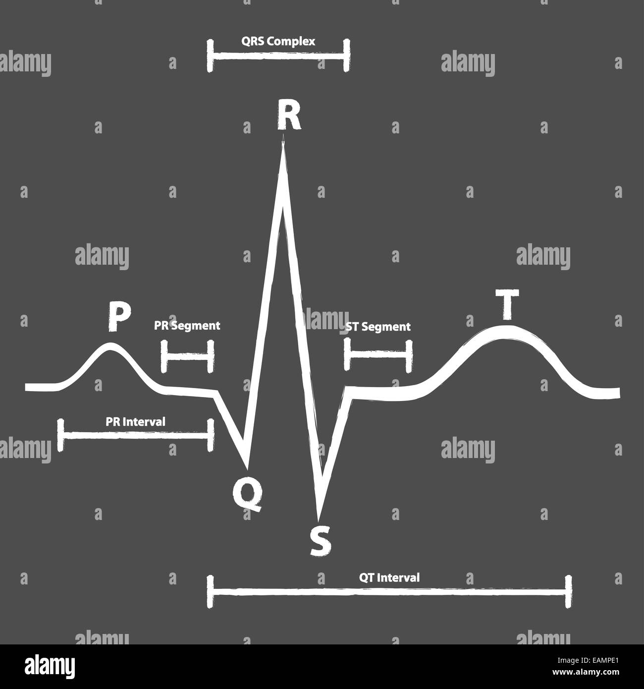 Normal Electrocardiogram Graphic Explained On Blackboard Stock Photo