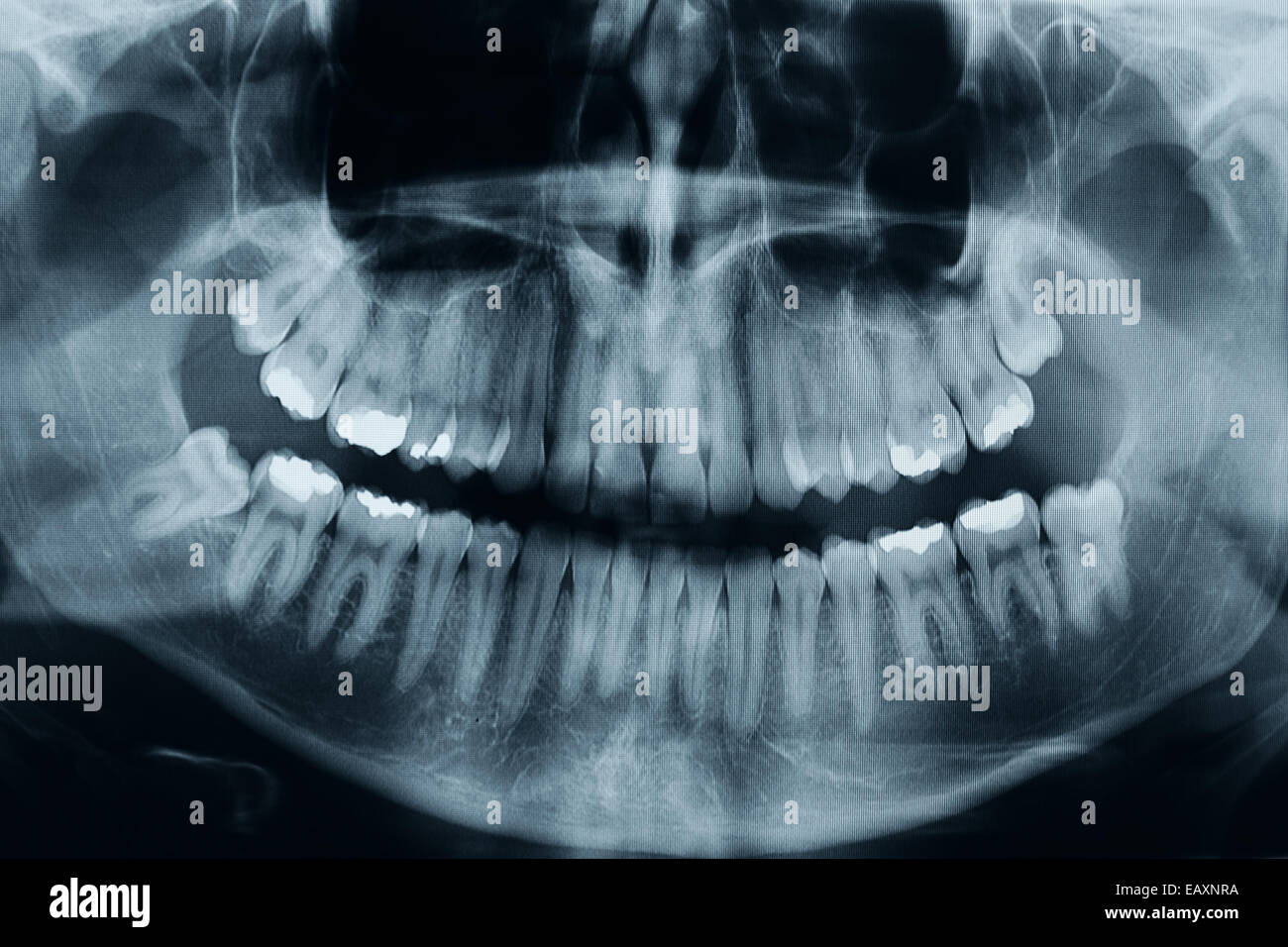 wisdom teeth xray wisdom teeth xray