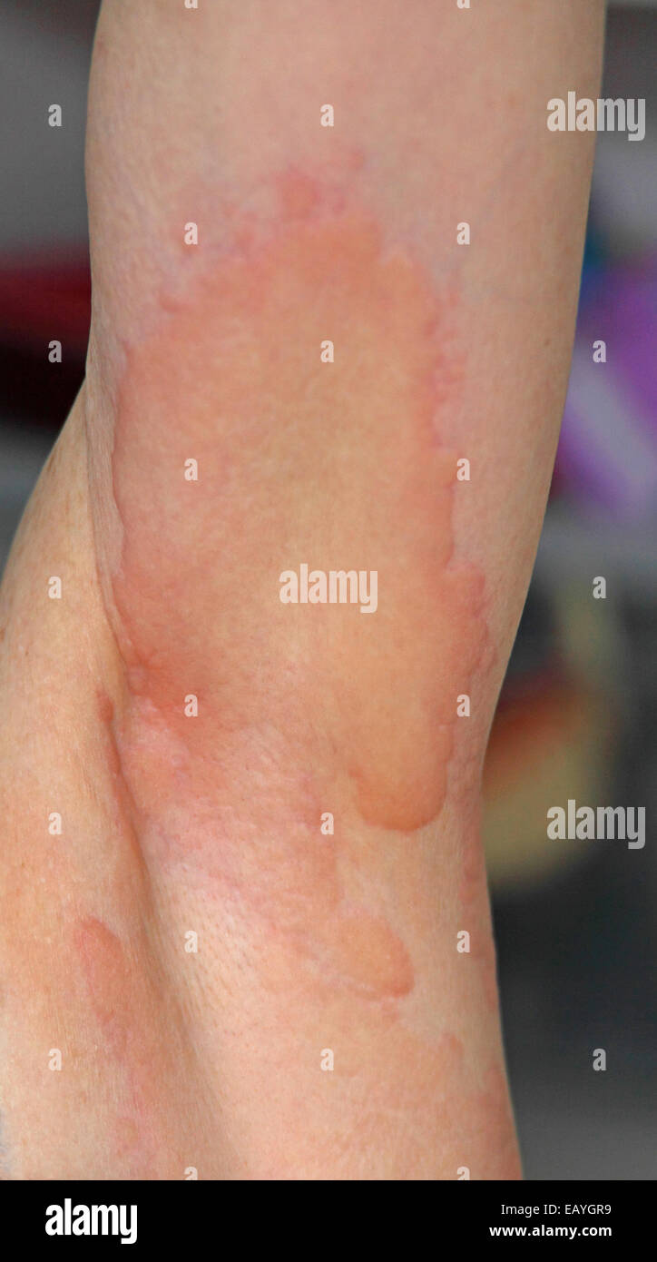 Underarm of female with severe urticaria at onset of M.E. Stock Photo