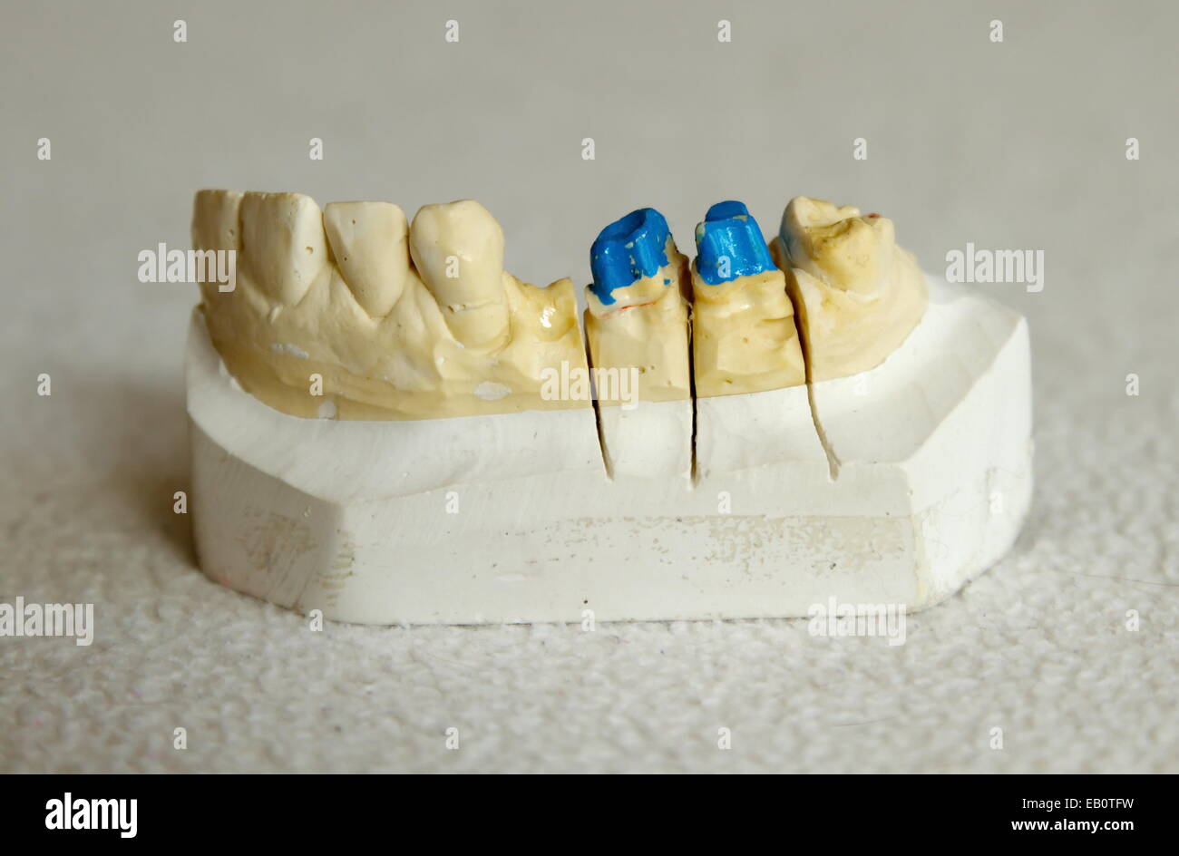 Zirconium or porcelain crown preparation on cast model Stock Photo Alamy