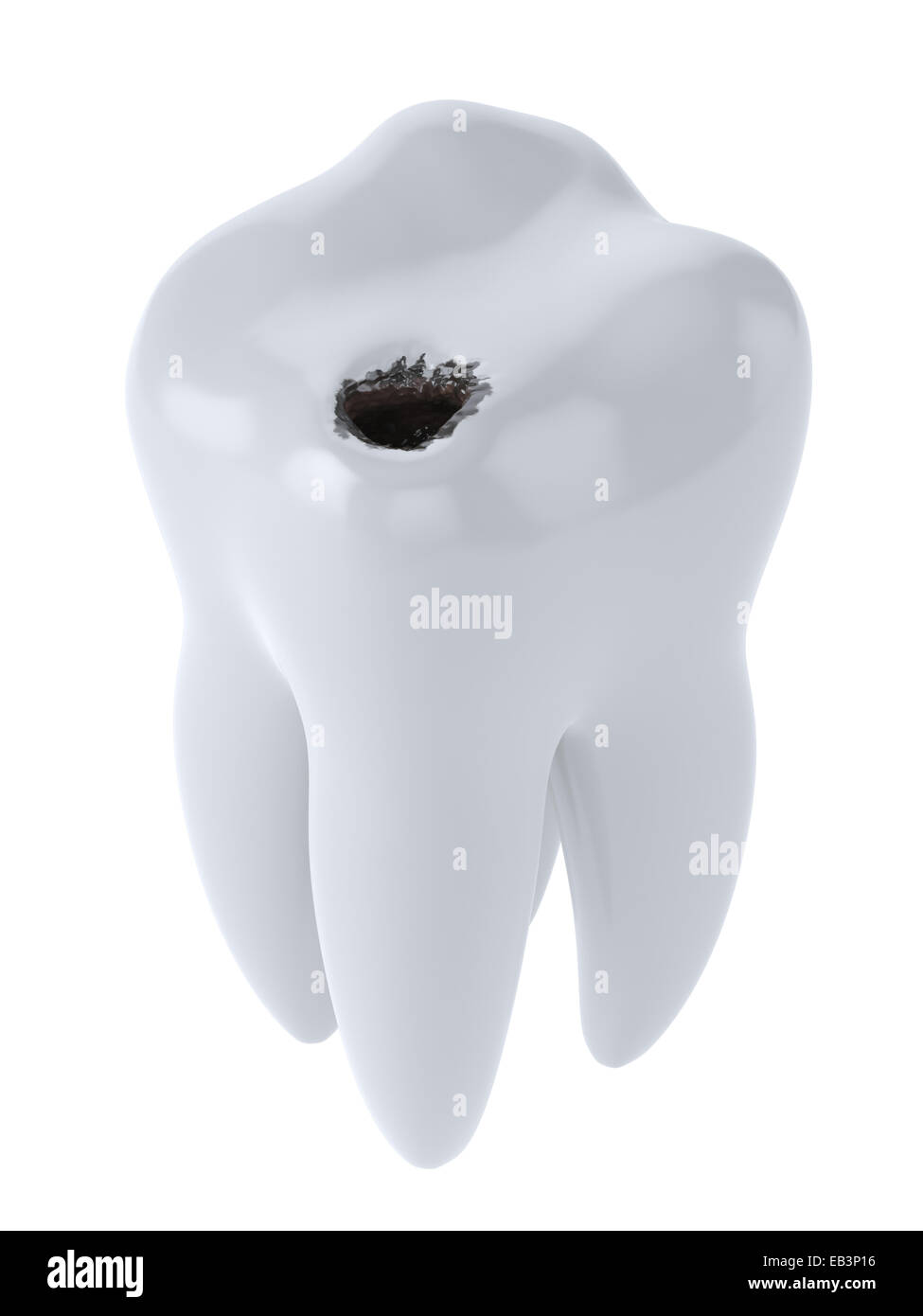 3d render of white tooth with black hole caries isolated on white ...