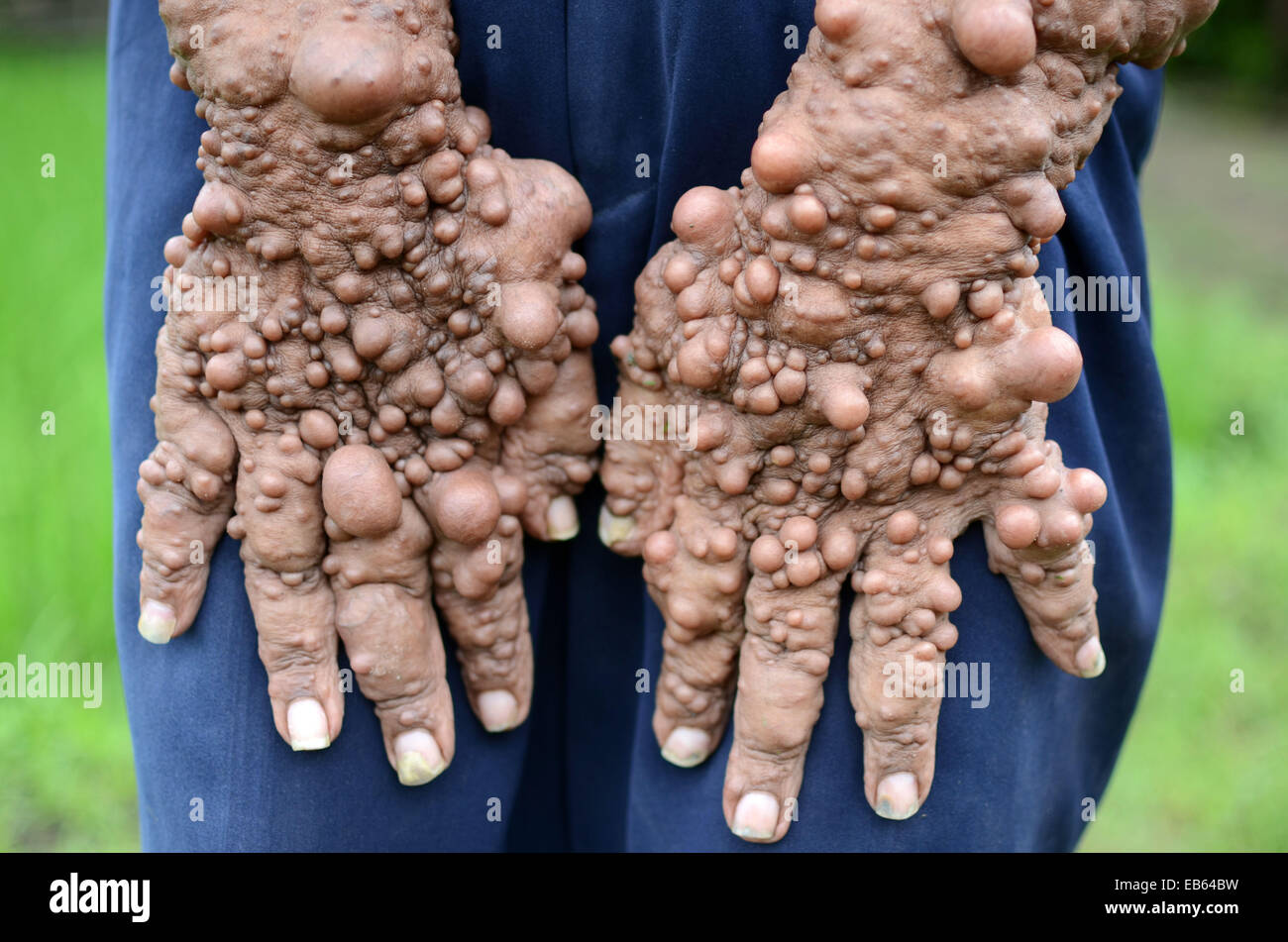 Slamet, 59, is believed to be suffering from neurofibromatosis• Genetic  condition which causes uncontrollable growths along the Stock Photo - Alamy