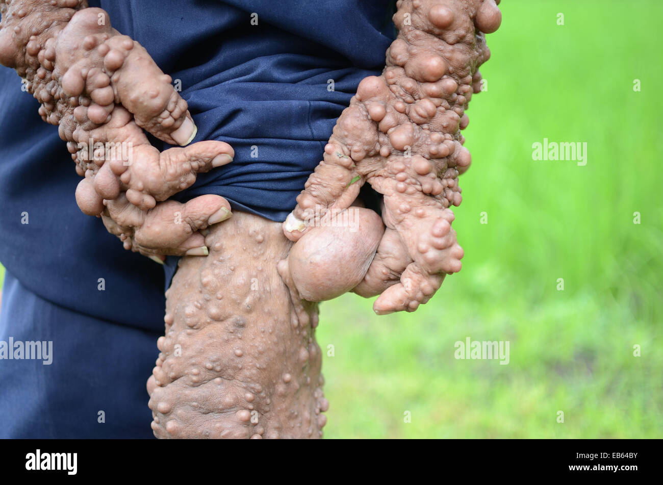 Slamet 59 Is Believed To Be Suffering From Neurofibromatosis Genetic Condition Which Causes Uncontrollable Growths Along The Stock Photo Alamy