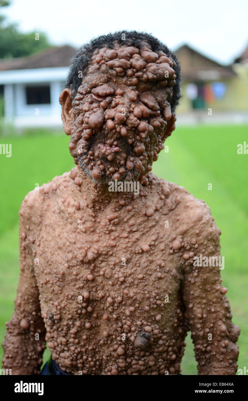 Slamet, 59, is believed to be suffering from neurofibromatosis•  Genetic condition which causes uncontrollable growths along the Stock Photo