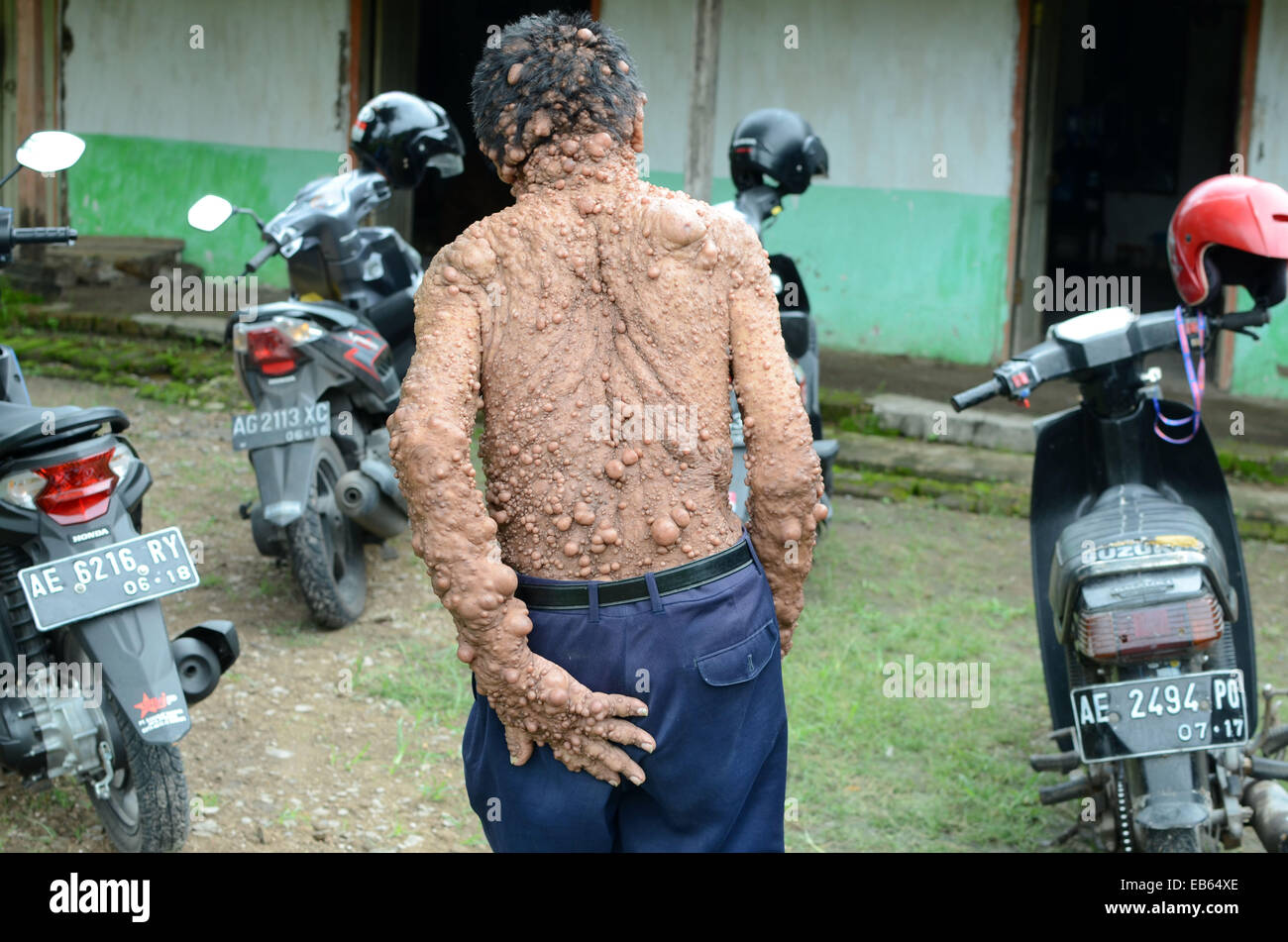 Slamet, 59, is believed to be suffering from neurofibromatosis. Genetic condition which causes uncontrollable growths along the Stock Photo
