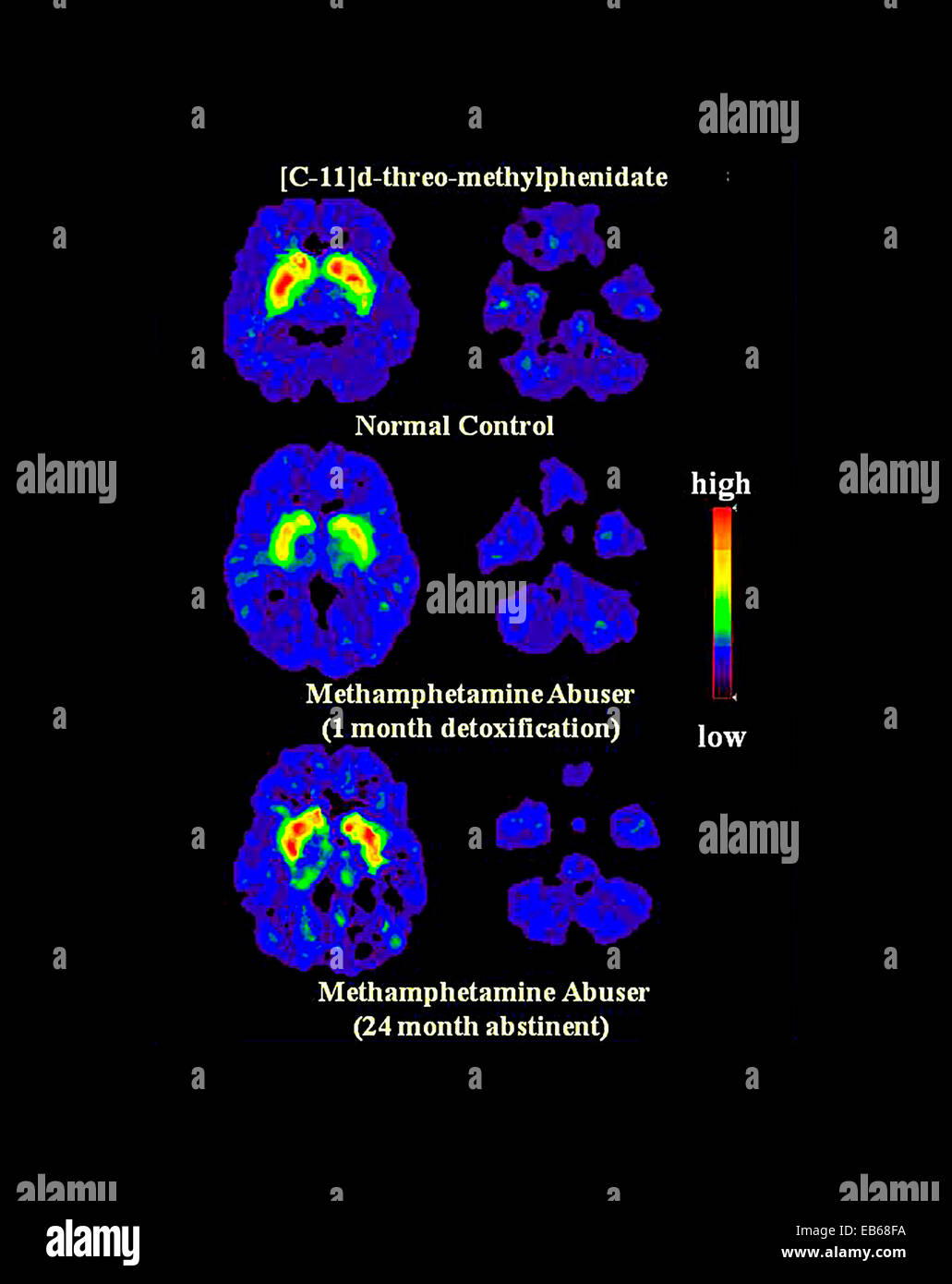 Dat brain scan hires stock photography and images Alamy
