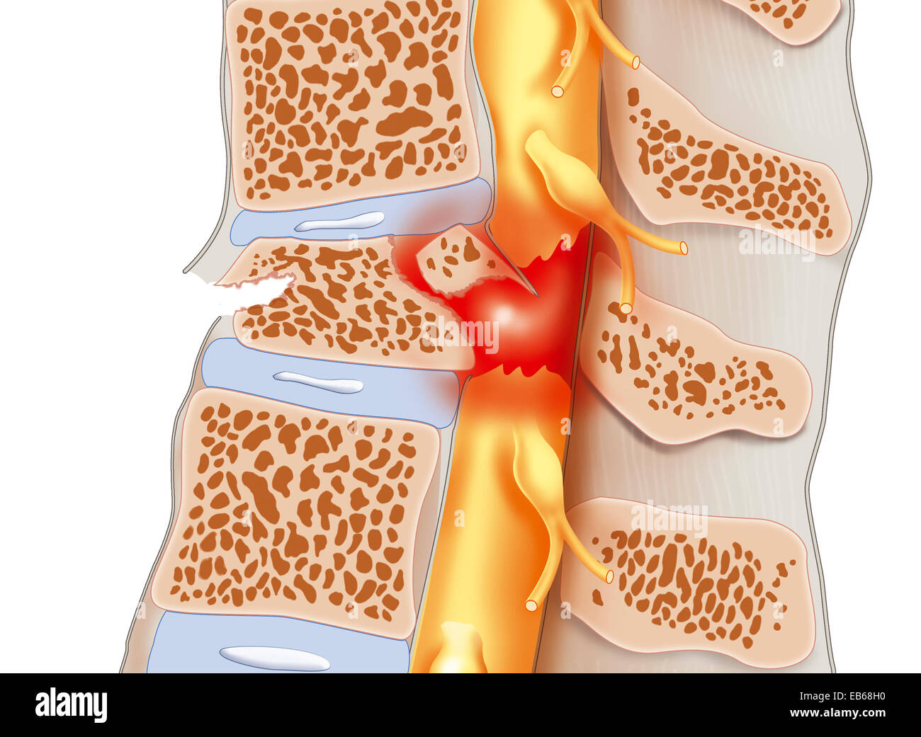 SPINAL CORD INJURY Stock Photo