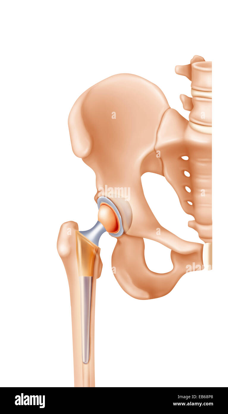 HIP PROSTHESIS, DRAWING Stock Photo