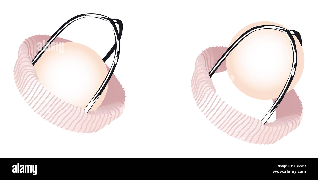 HEART VALVE PROSTHESIS Stock Photo - Alamy