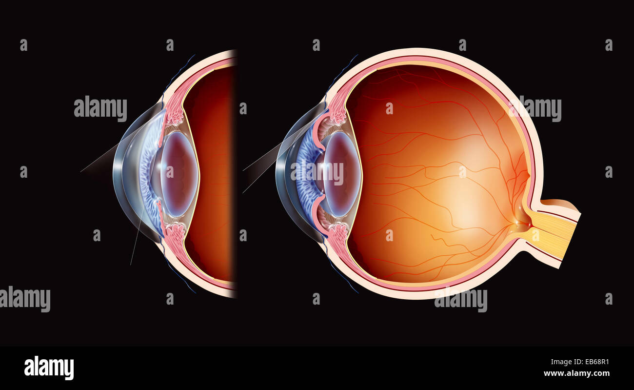 GLAUCOMA, DRAWING Stock Photo