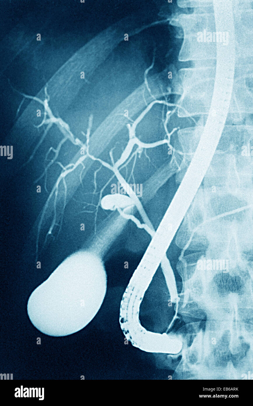 Primary Sclerosing Cholangitis Stock Photo 75742903 Alamy Primary Sclerosing Cholangitis Stock Photo 75742903 Alamy