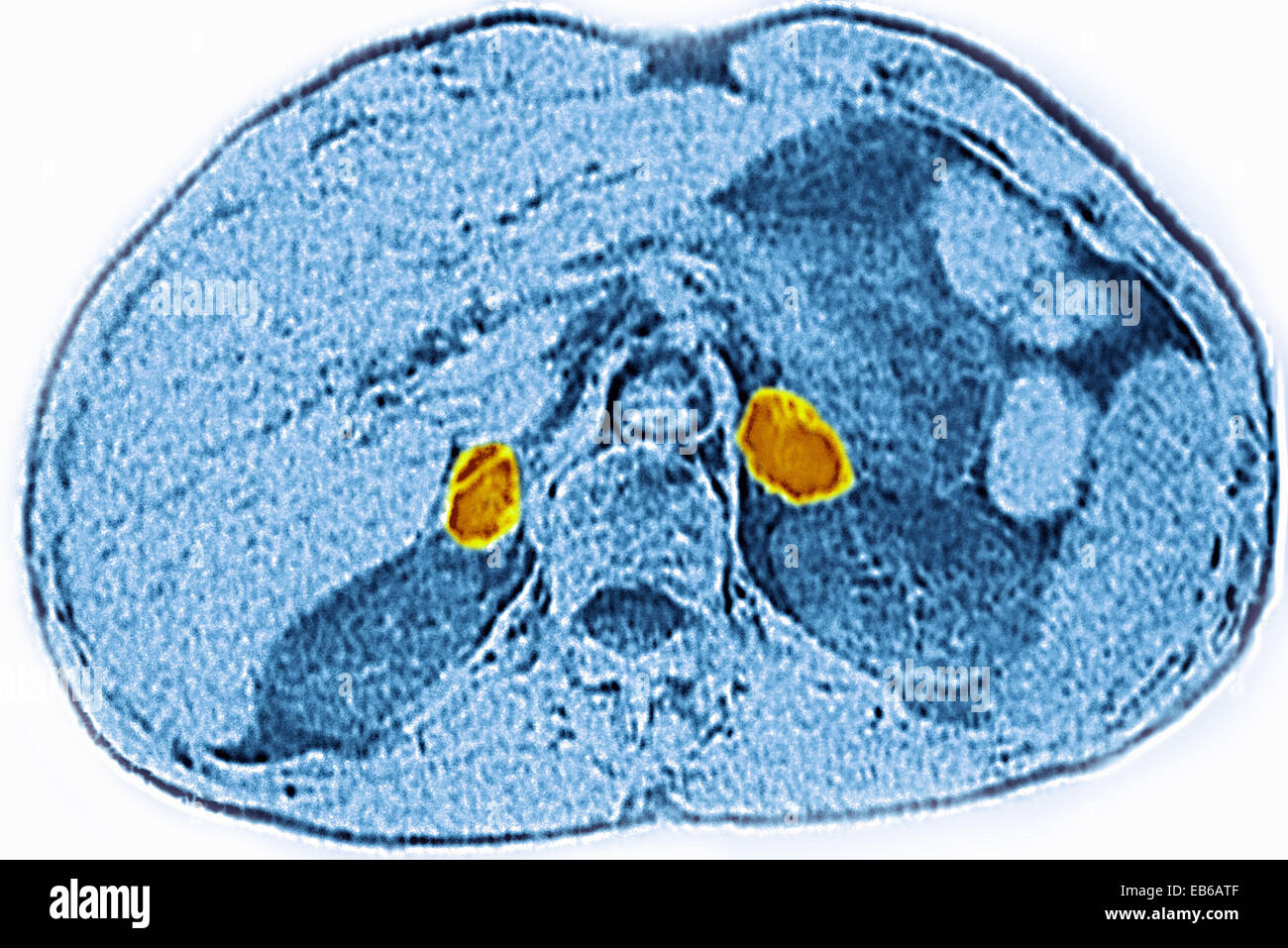ADRENAL GLAND, CT SCAN Stock Photo Alamy