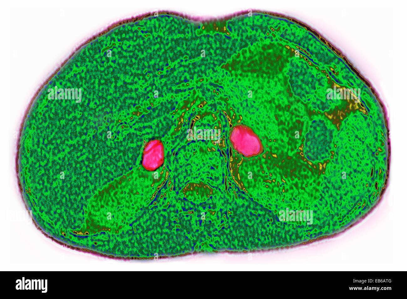 ADRENAL GLAND, CT SCAN Stock Photo
