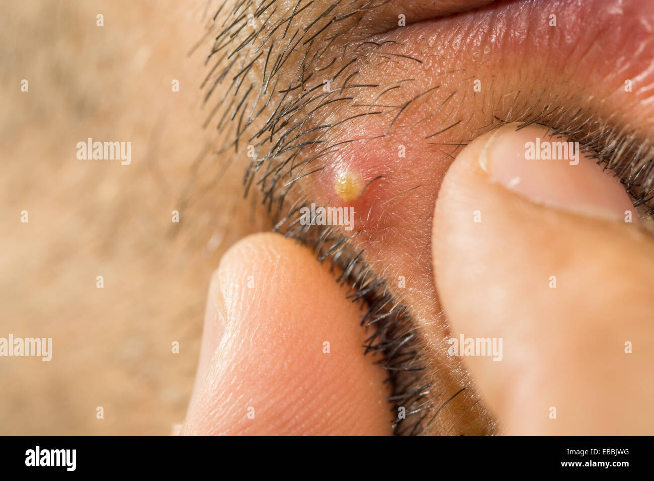 Extreme closeup of caucasian man with stub squeezing a pimple Stock Photo