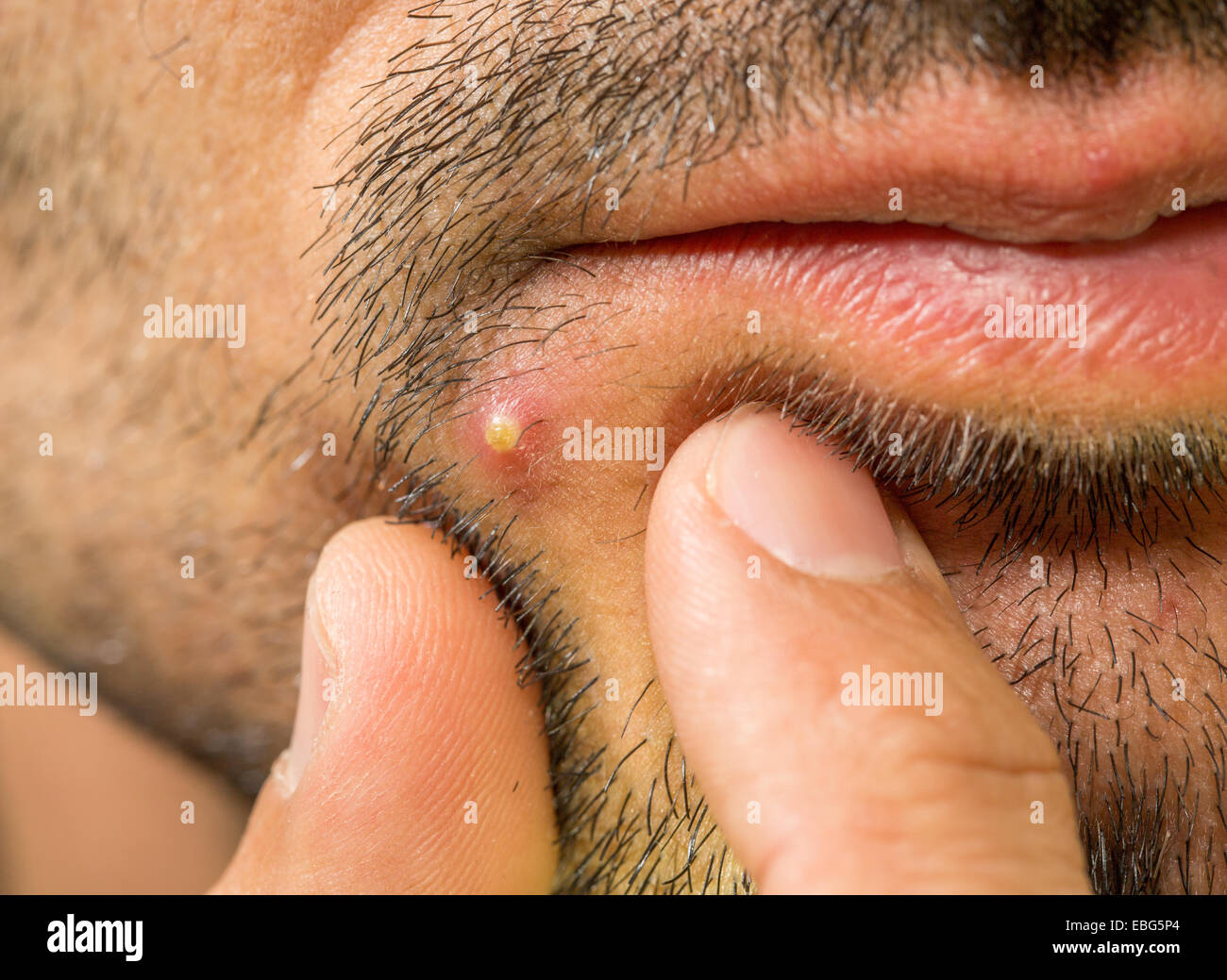 Caucasian man with stub and big pimple with 2 fingers Stock Photo