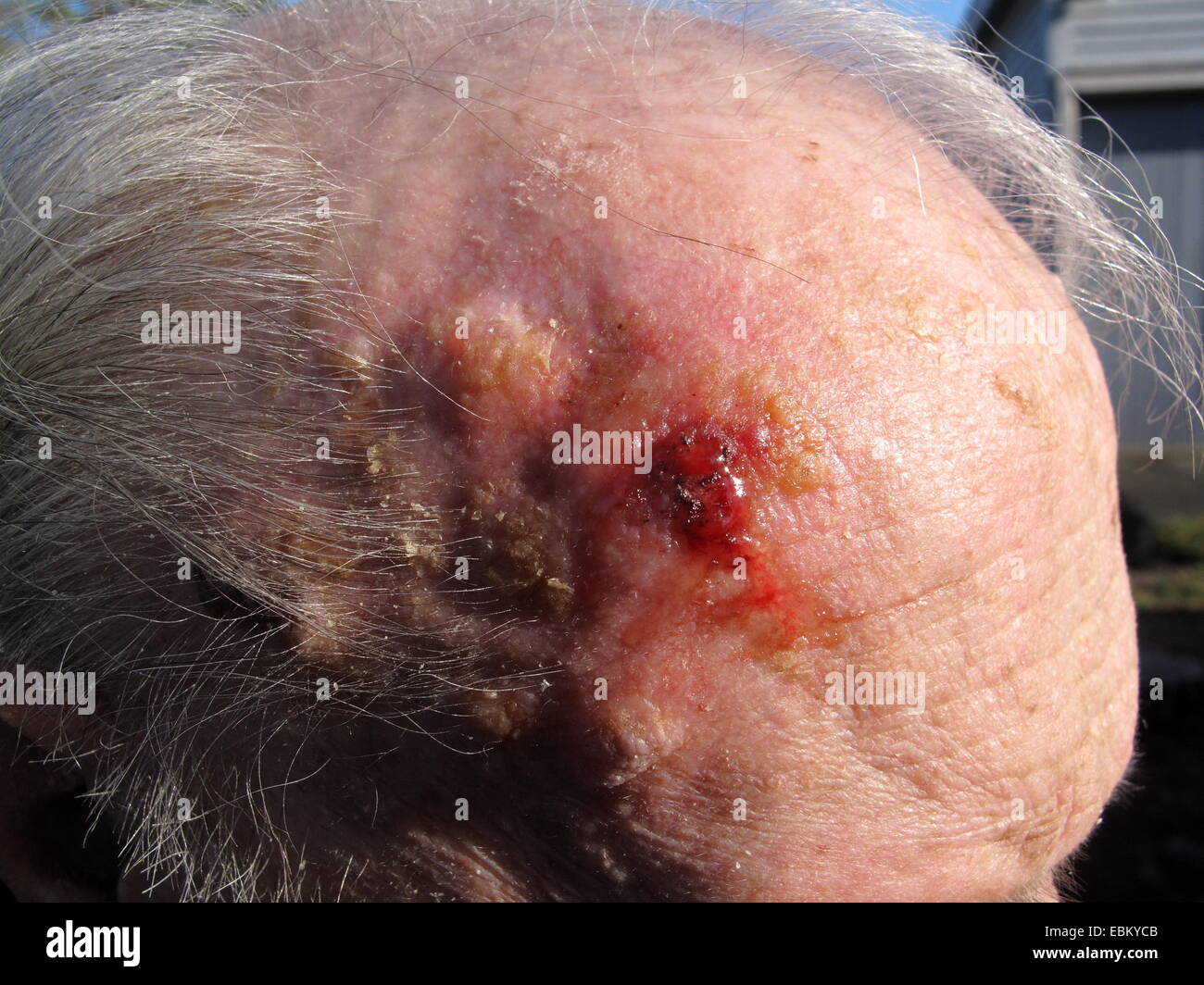 Squamous-cell carcinoma or squamous cell cancer on the head of an elderly man Stock Photo