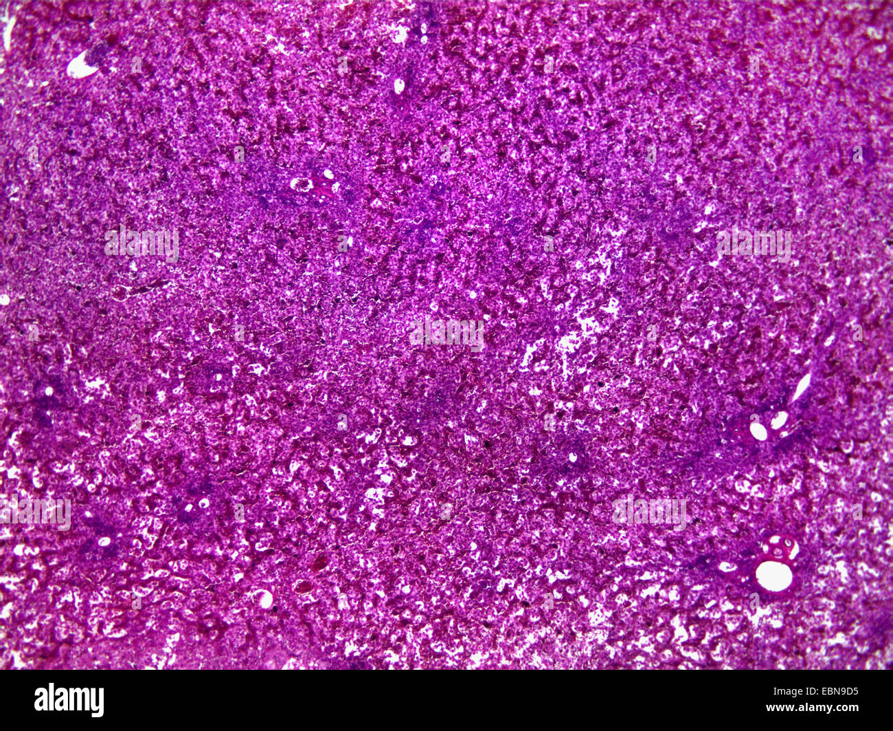 secondary hepatic cancer, microscopical section, 40 x Stock Photo