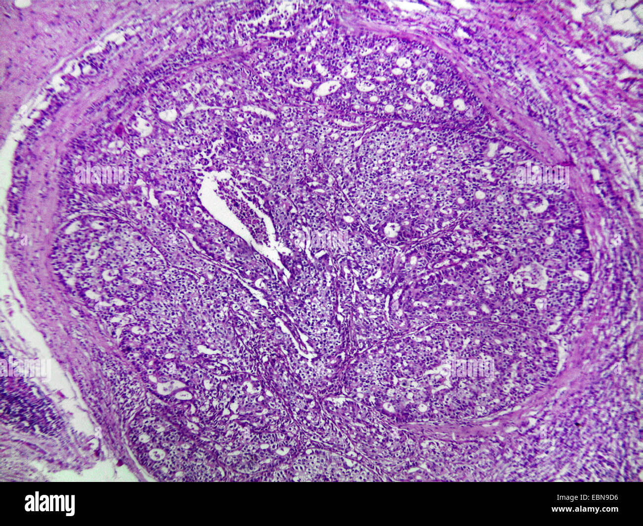 gastric carcinoma, microscopical section, 100 x Stock Photo