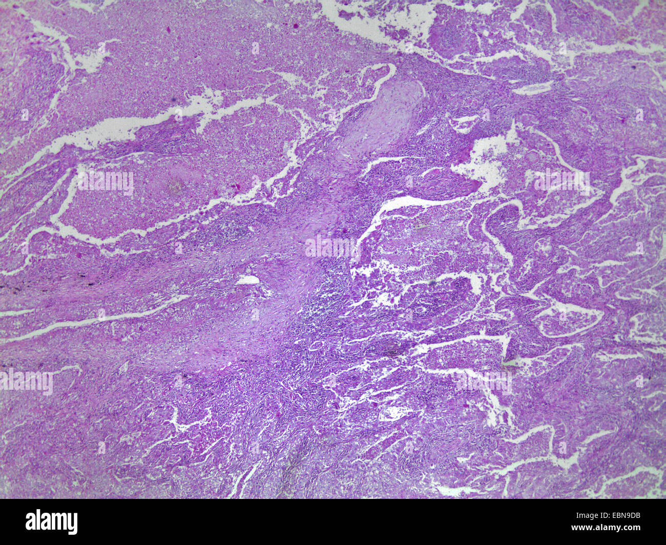 lung carcinoma, microscopical section, 40 x Stock Photo