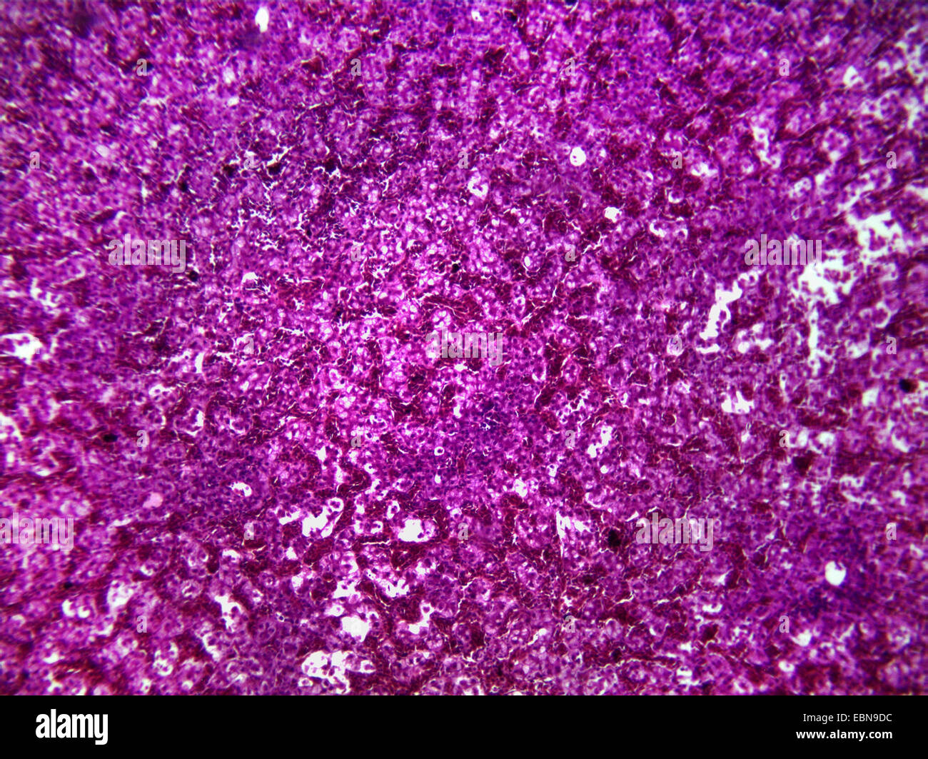 secondary hepatic cancer, microscopical section, 100 x Stock Photo