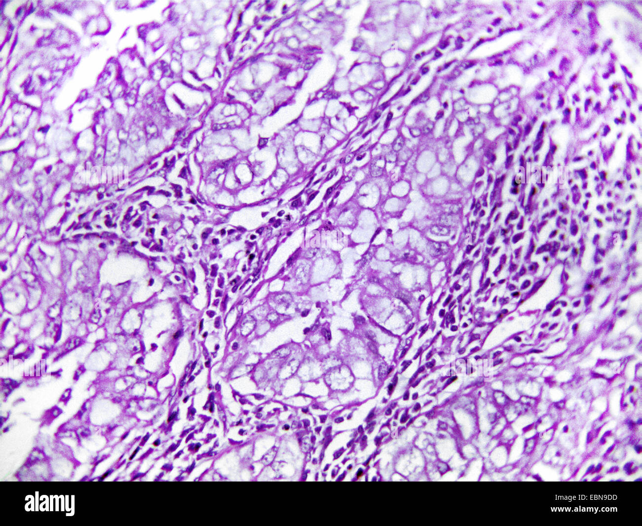 lung carcinoma, microscopical section, 400 x Stock Photo