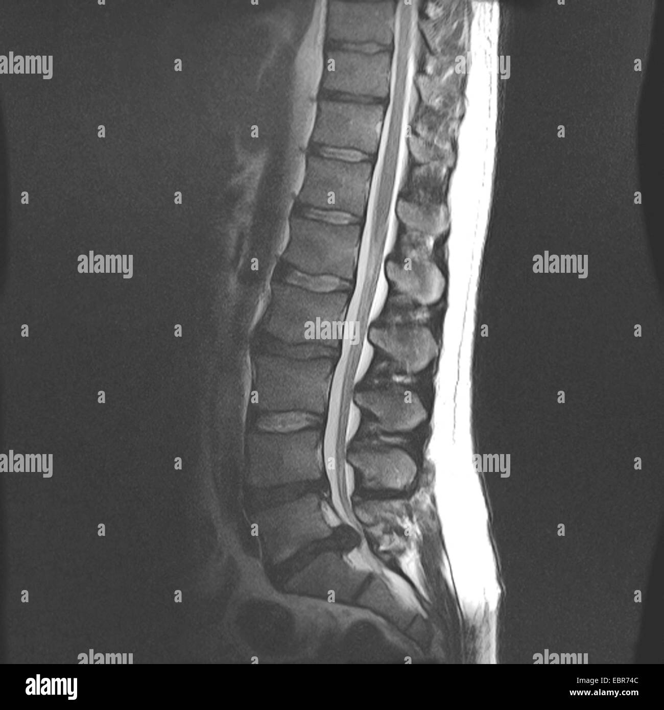 X-ray photograph of spinal disc herniation between S5/L1 Stock Photo