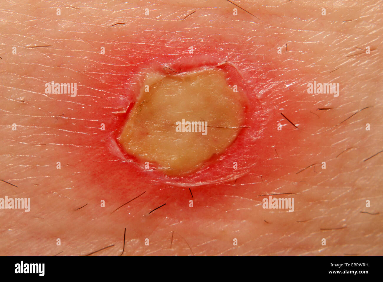 skin with burn wound Stock Photo
