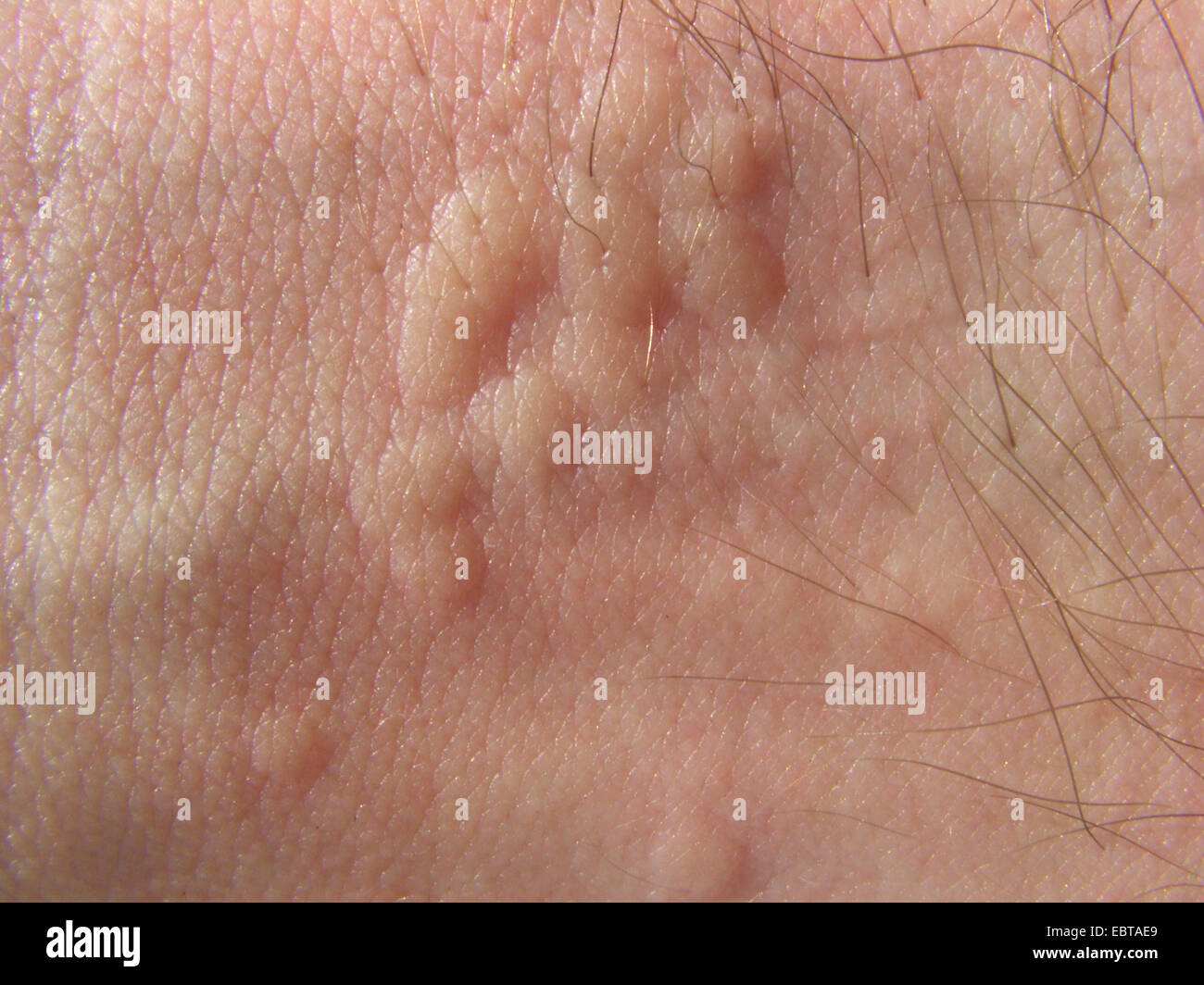 stinging nettle (Urtica dioica), med. skin irritation caused by stinging nettles, Germany Stock Photo