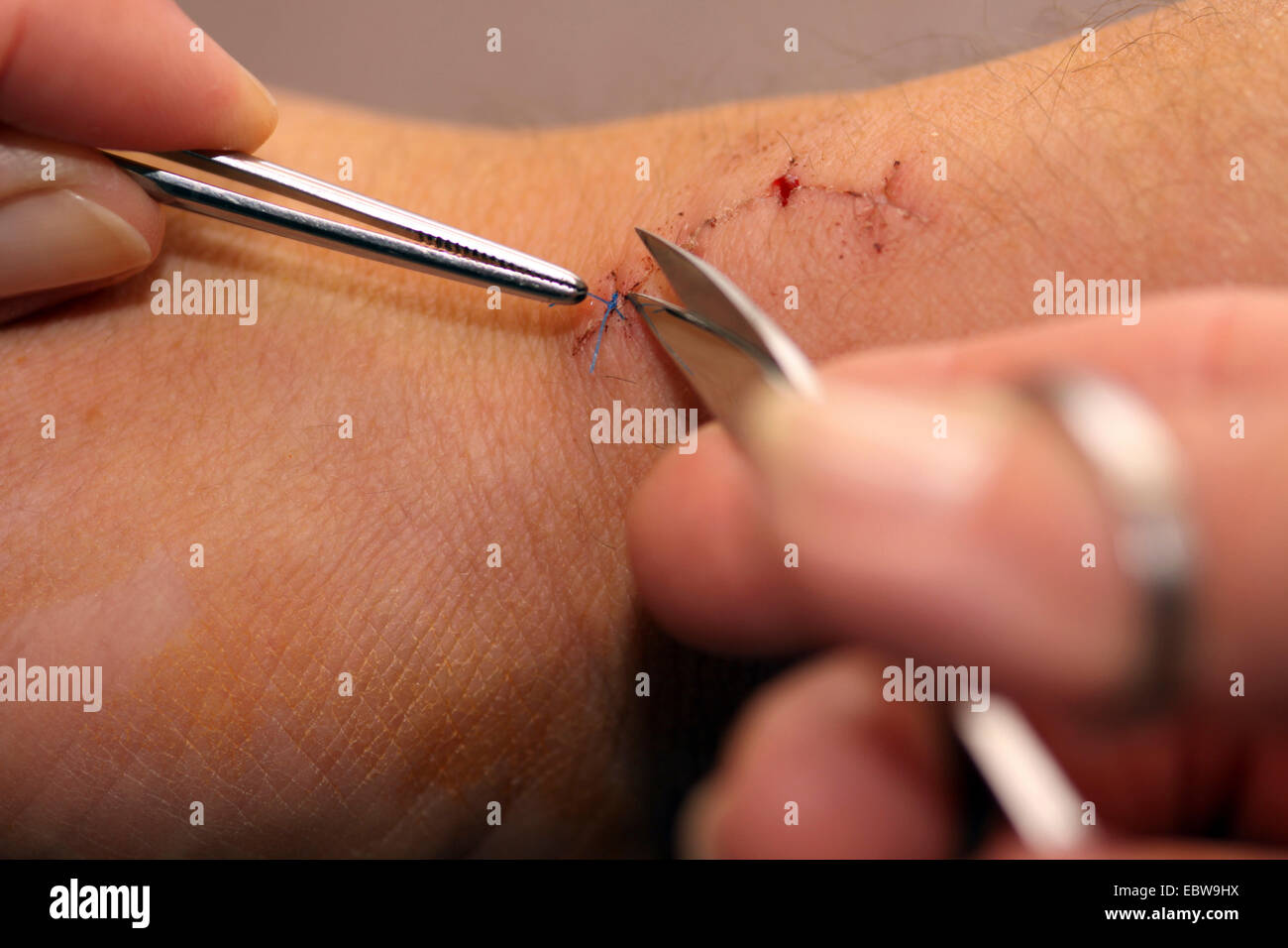 stitches of a scar at a carpus being removed with pincers and scissors Stock Photo