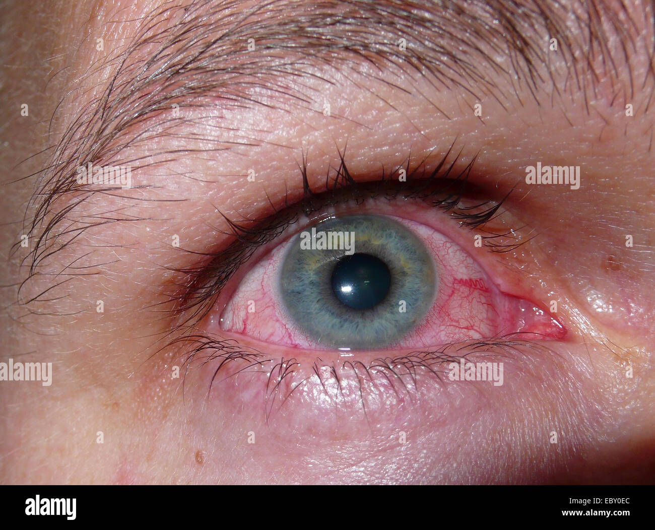 eye of a man with allergic coryza Stock Photo