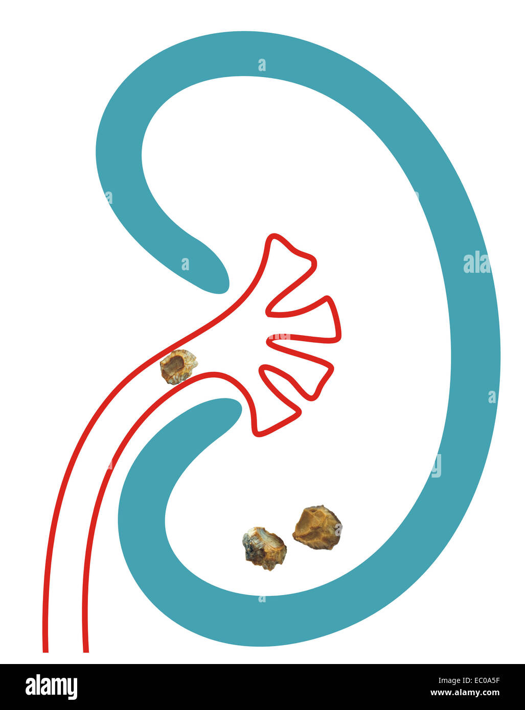 Kidney stones after ESWL intervention. Lithotripsy Stock Photo