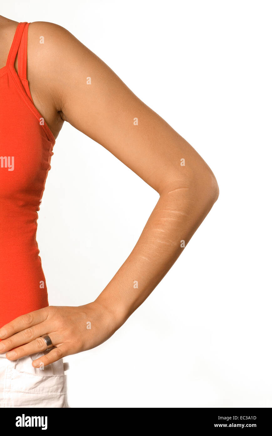 Arm of a Woman with Scars on the Forearm Stock Photo Alamy