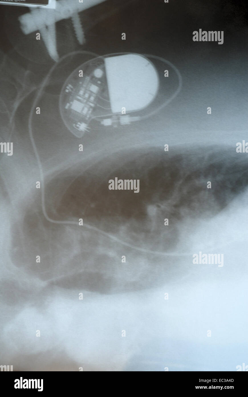 Chest Xray of a Cardiac Pacemaker Stock Photo Alamy
