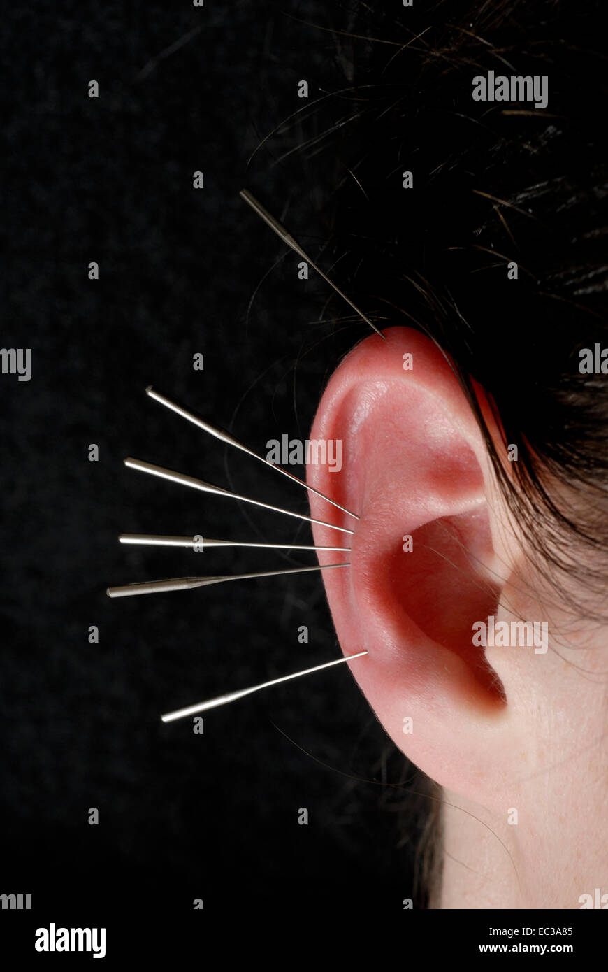 Acupuncture Needles in the Ear Stock Photo Alamy