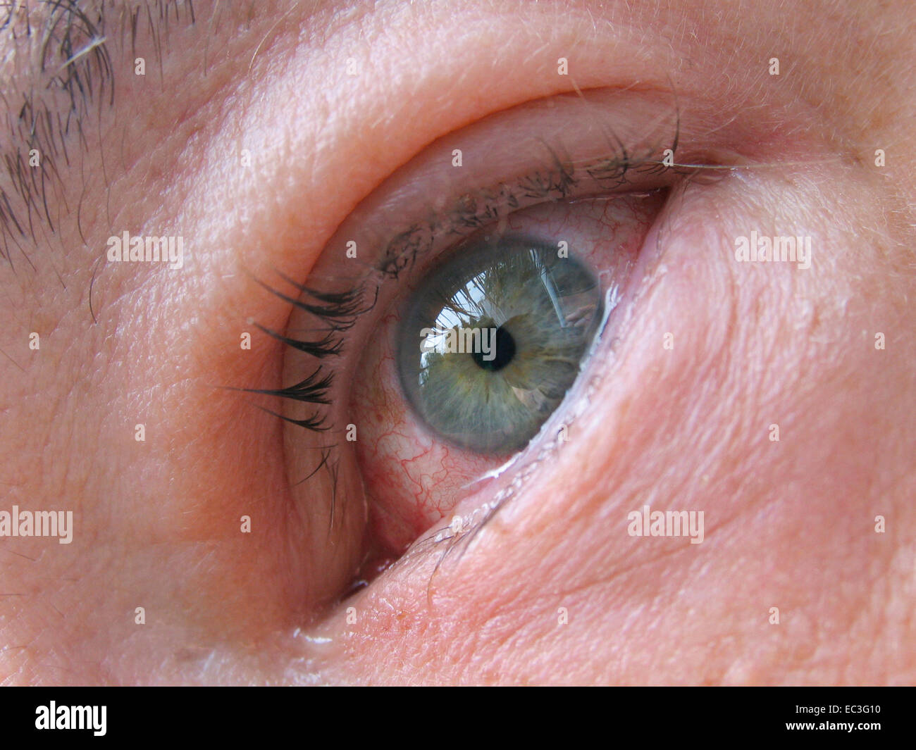 heavily inflammed eye Stock Photo