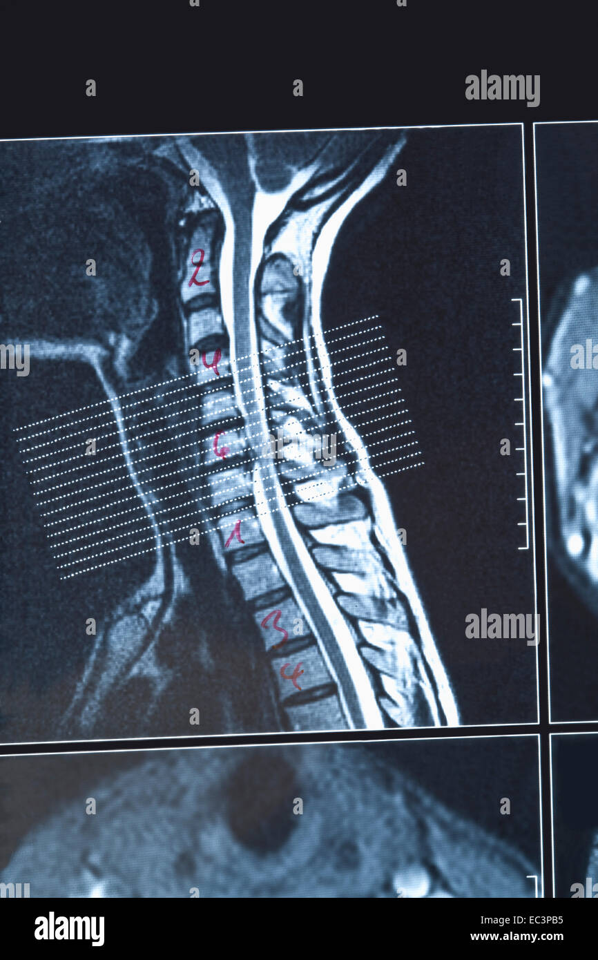 Ct of the cervical spine hi-res stock photography and images - Alamy
