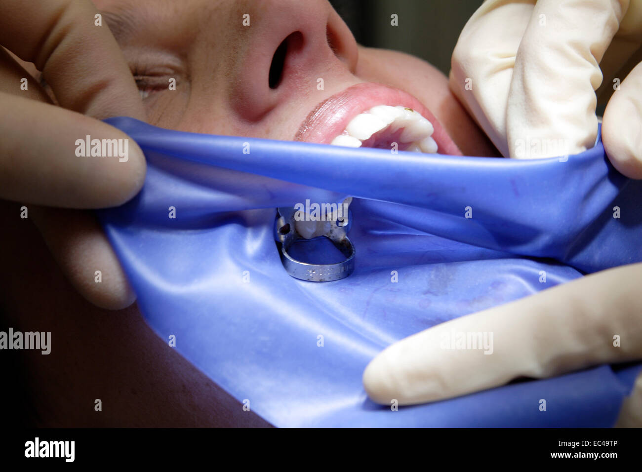 Dental dam hires stock photography and images Alamy