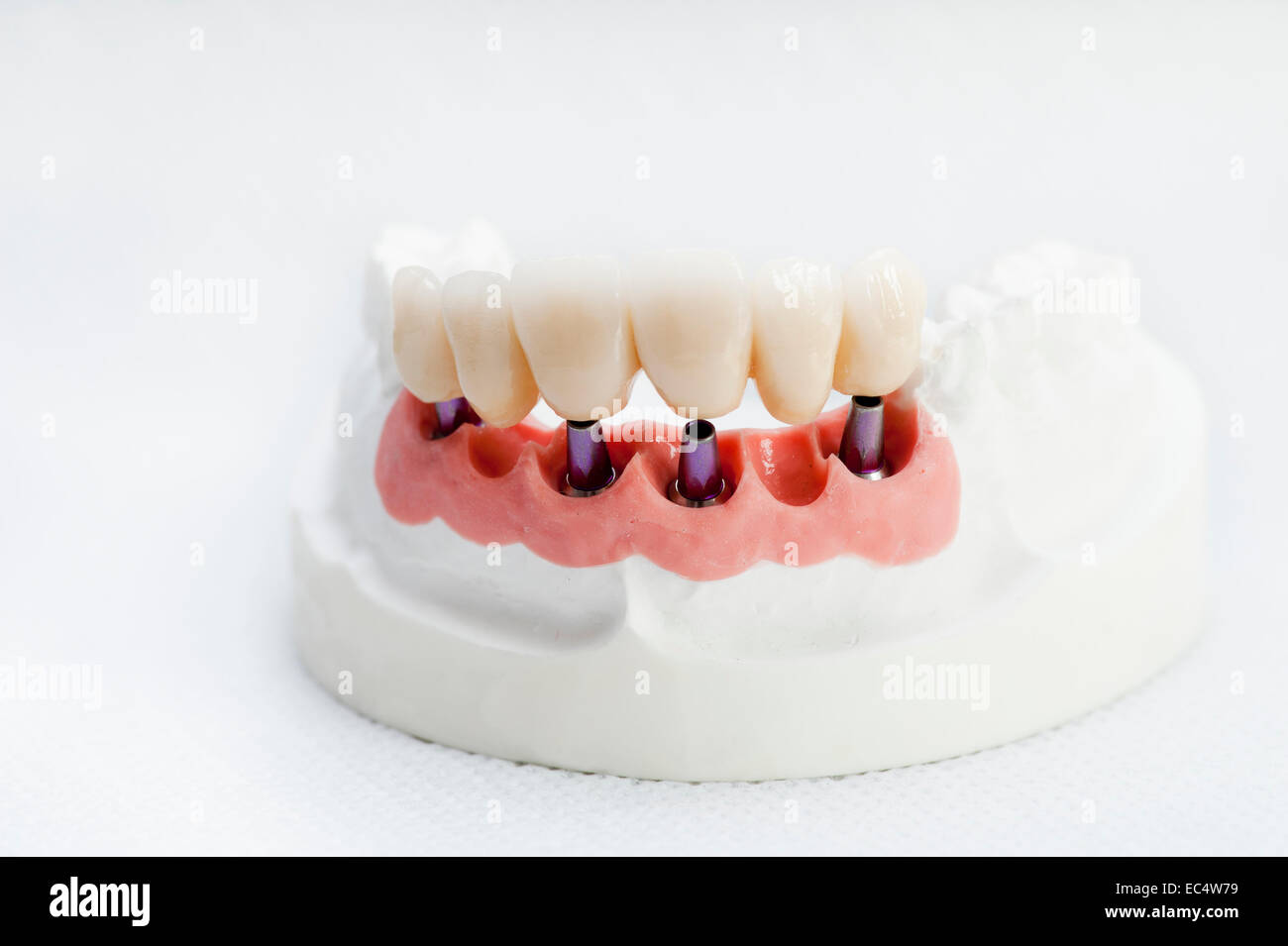 Dental crowns on the pins in the jaw model Stock Photo Alamy