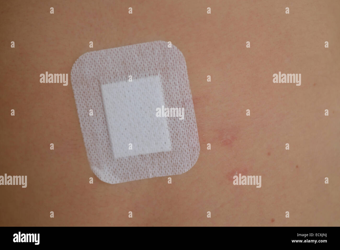 Excoriation hires stock photography and images Alamy