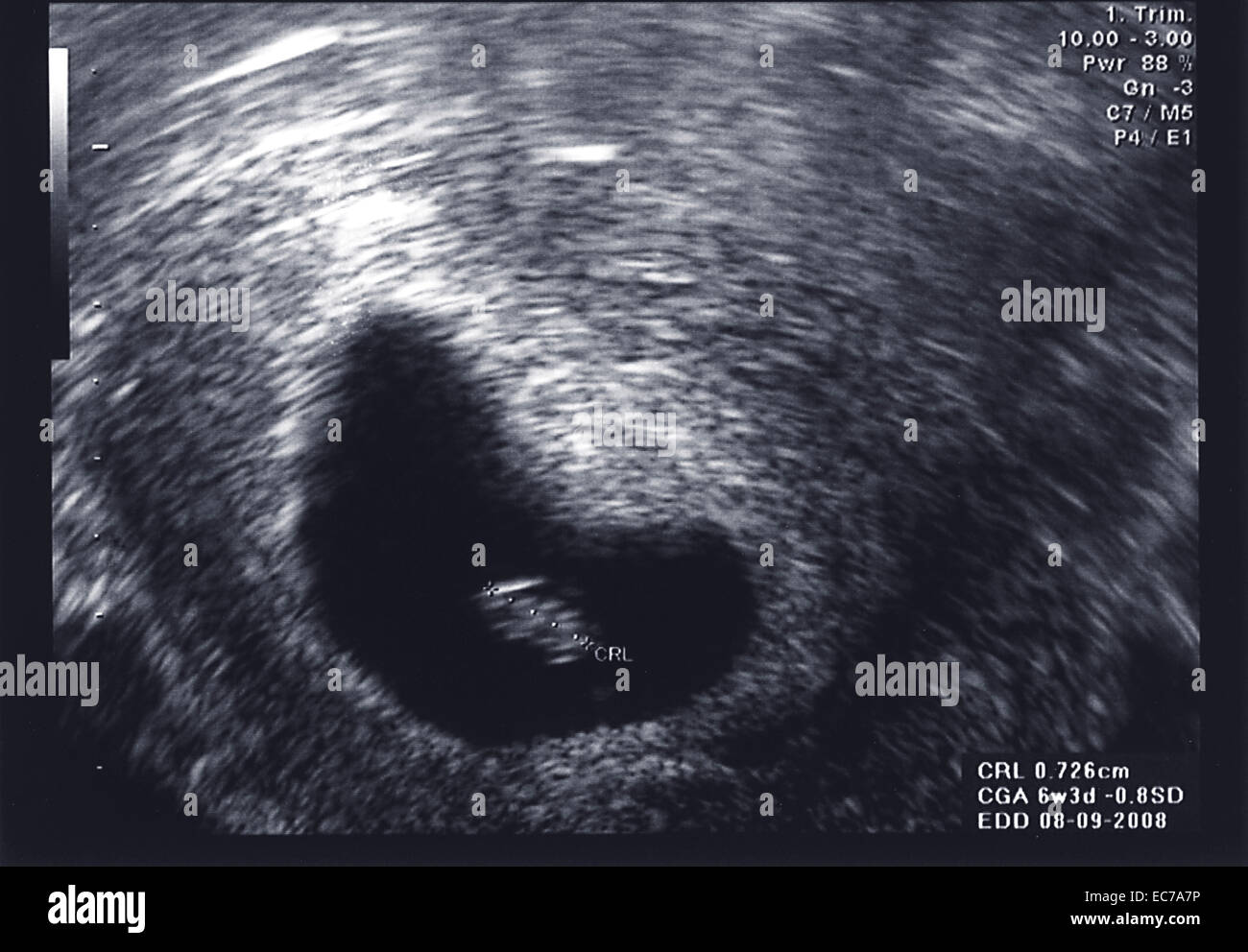 Ultrasound scan of fetus at first trimester Stock Photo Alamy